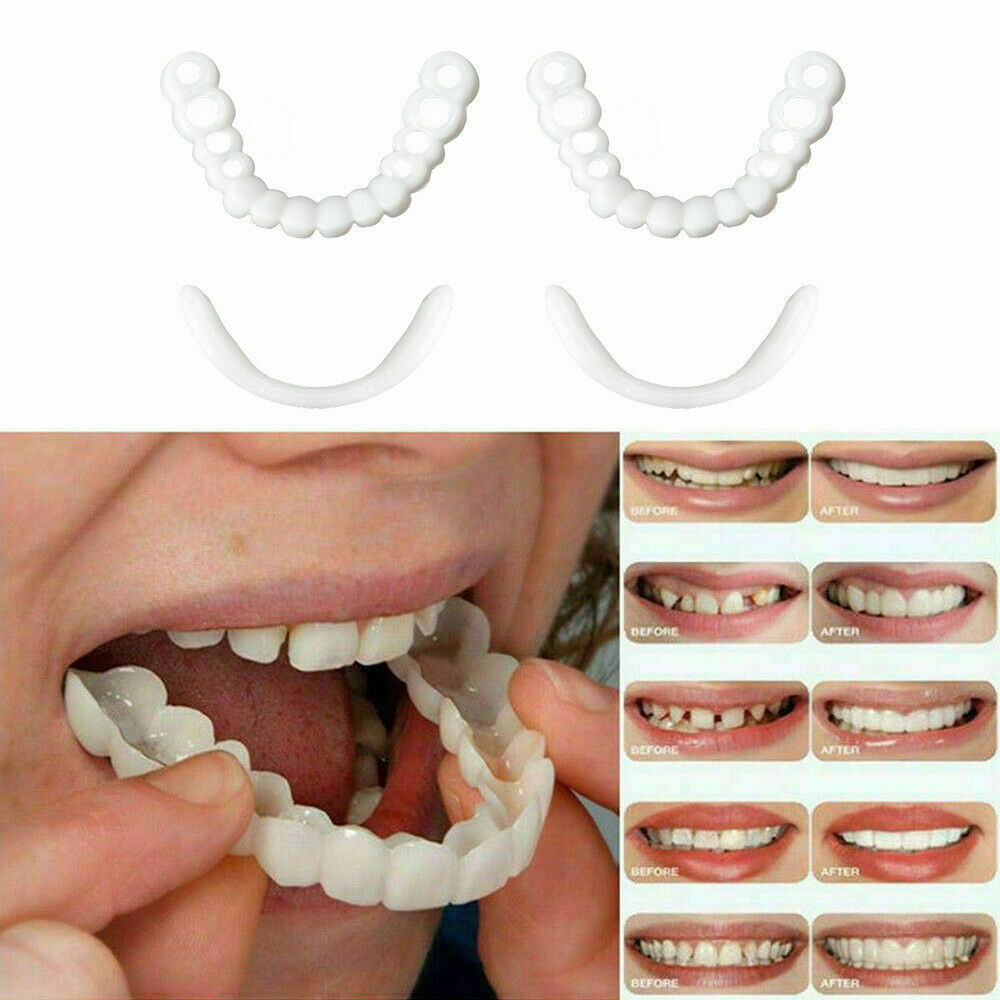 SnapOn Smile Veneers